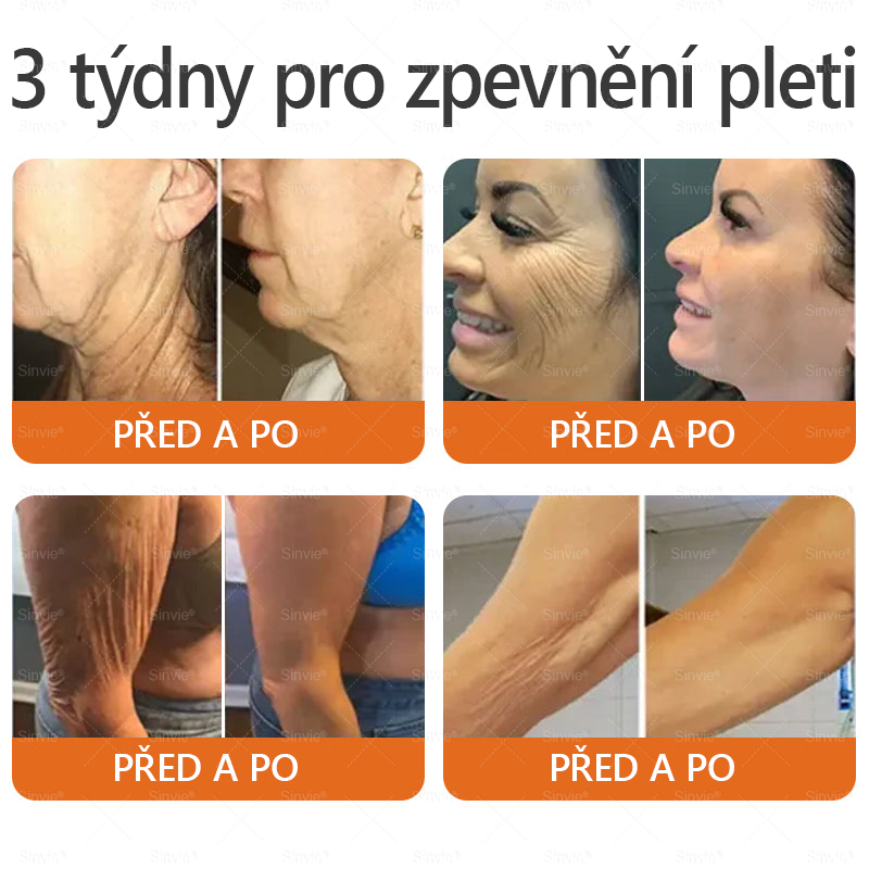 👨‍⚕‍Sinvie® Krém na obnovu pleti s včelím jedem CE schváleno,Přírodní složky trvale odstraňují skvrny, pihy a sluneční skvrny, bojují proti vráskám a povolené pokožce — 50 ml🐝🐝