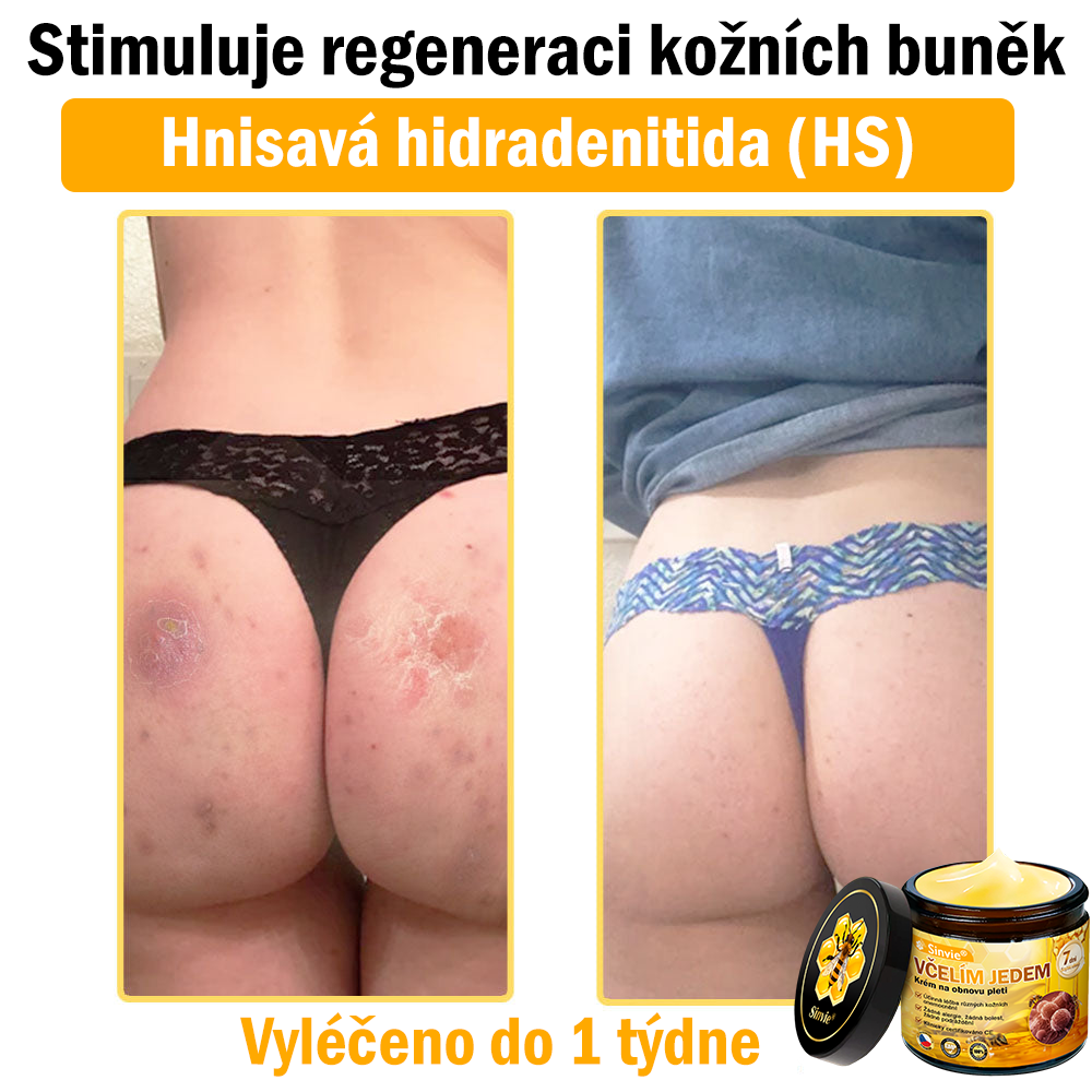 👨‍⚕‍Sinvie® Krém na obnovu pleti s včelím jedem CE schváleno,Přírodní složky trvale odstraňují skvrny, pihy a sluneční skvrny, bojují proti vráskám a povolené pokožce — 50 ml🐝🐝