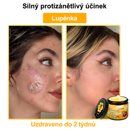 👨‍⚕‍Sinvie® Krém na obnovu pleti s včelím jedem CE schváleno,Přírodní složky trvale odstraňují skvrny, pihy a sluneční skvrny, bojují proti vráskám a povolené pokožce — 50 ml🐝🐝